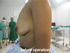 plastic-surgery-breast-augmentation