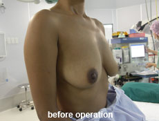 plastic-surgery-breast-augmentation