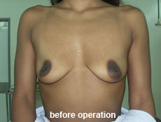 plastic-surgery-breast-augmentation