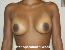 plastic-surgery-breast-augmentation