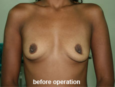 plastic-surgery-breast-augmentation