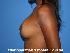 plastic-surgery-breast-augmentation