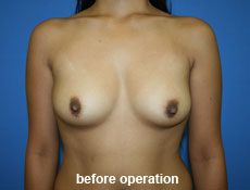 plastic-surgery-breast-augmentation
