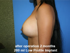 plastic-surgery-breast-augmentation
