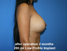 plastic-surgery-breast-augmentation
