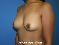 plastic-surgery-breast-augmentation
