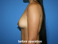 plastic-surgery-breast-augmentation