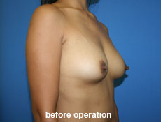 plastic-surgery-breast-augmentation