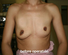 plastic-surgery-breast-augmentation