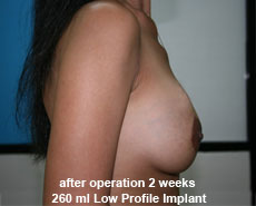 plastic-surgery-breast-augmentation