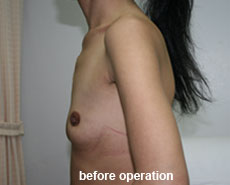plastic-surgery-breast-augmentation