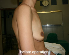 plastic-surgery-breast-augmentation
