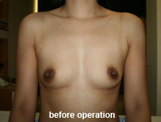 plastic-surgery-breast-augmentation