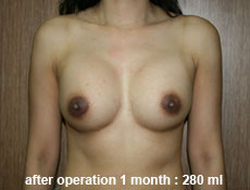 plastic-surgery-breast-augmentation