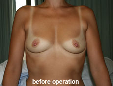 plastic-surgery-breast-augmentation