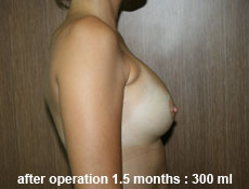 plastic-surgery-breast-augmentation