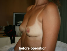 plastic-surgery-breast-augmentation