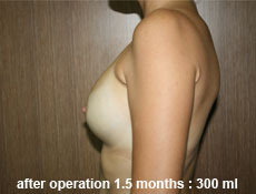 plastic-surgery-breast-augmentation