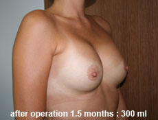 plastic-surgery-breast-augmentation