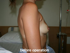 plastic-surgery-breast-augmentation