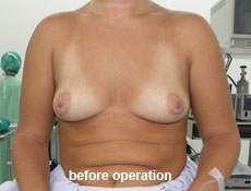 plastic-surgery-breast-augmentation