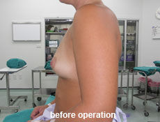 plastic-surgery-breast-augmentation