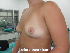 plastic-surgery-breast-augmentation