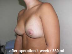 plastic-surgery-breast-augmentation
