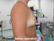 plastic-surgery-breast-augmentation