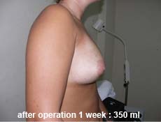 plastic-surgery-breast-augmentation