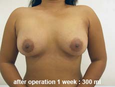 plastic-surgery-breast-augmentation