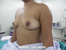 plastic-surgery-breast-augmentation