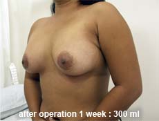 plastic-surgery-breast-augmentation