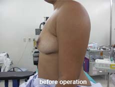 plastic-surgery-breast-augmentation