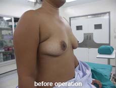 plastic-surgery-breast-augmentation
