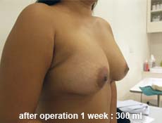 plastic-surgery-breast-augmentation