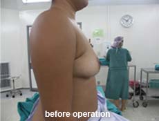 plastic-surgery-breast-augmentation