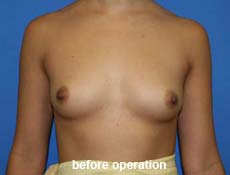 plastic-surgery-breast-augmentation 