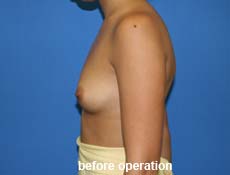 plastic-surgery-breast-augmentation 