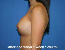 plastic-surgery-breast-augmentation 