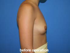 plastic-surgery-breast-augmentation 