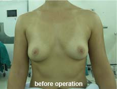plastic-surgery-breast-augmentation