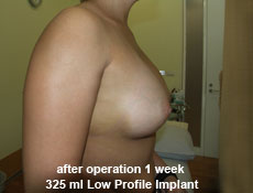 plastic-surgery-breast-augmentation