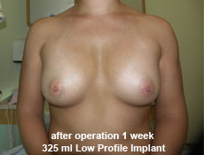 plastic-surgery-breast-augmentation
