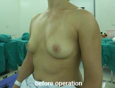 plastic-surgery-breast-augmentation