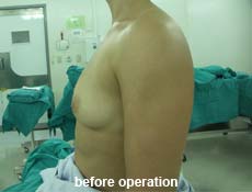 plastic-surgery-breast-augmentation