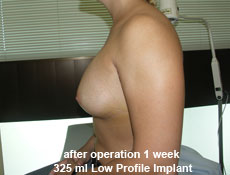 plastic-surgery-breast-augmentation