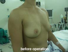 plastic-surgery-breast-augmentation