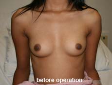 plastic-surgery-breast-augmentation