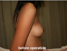 plastic-surgery-breast-augmentation